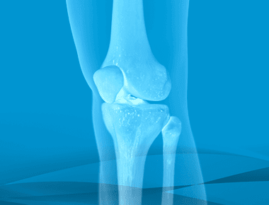 Total Knee Replacement