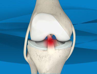 How Long Does It Take for a Torn Meniscus to Heal Without Surgery?