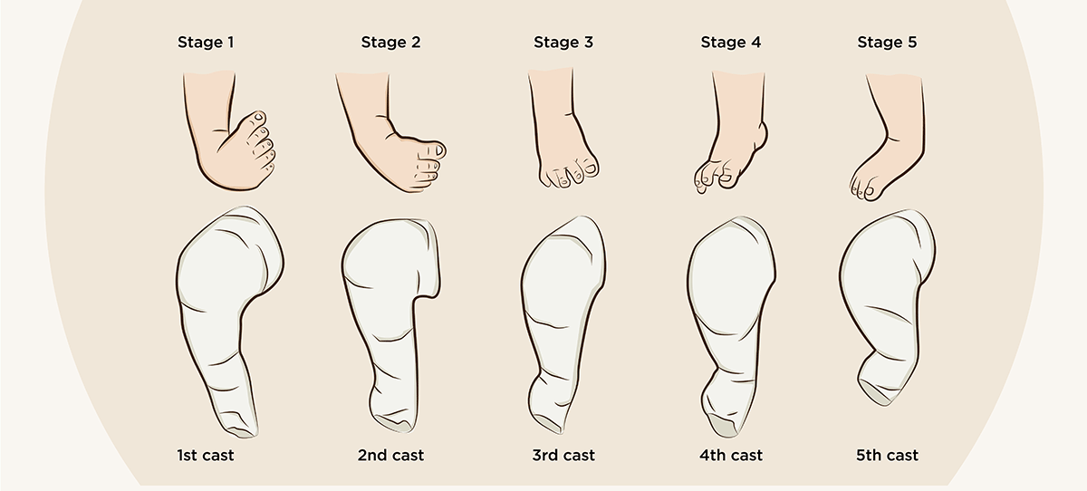 Stages of clubfoot in babies